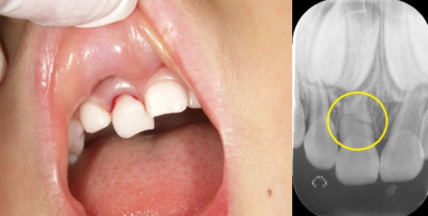 乳歯の外傷治療例 | つしまスマイル歯科クリニック